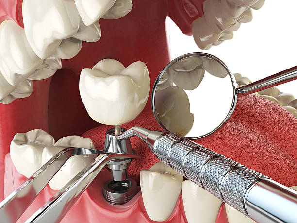 Best Emergency Root Canal Therapy in New Haven, MO